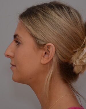 Rhinoplasty Before & After Patient #2115