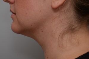 Neck Liposuction Before & After Patient #2008