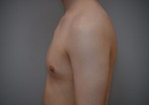 Gynecomastia Before & After Patient #1160