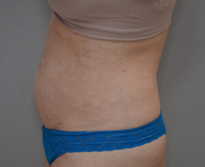 Liposuction with Bodytite Before & After Patient #1558