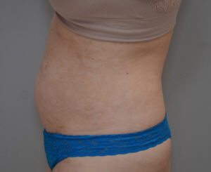 Bodytite Before & After Patient #1558