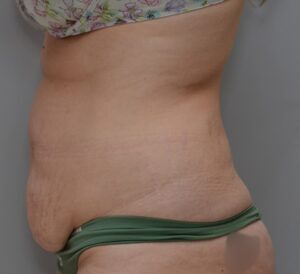 Abdominoplasty Before & After Patient #1496