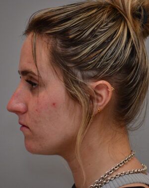 Rhinoplasty Before & After Patient #2116