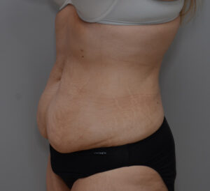 Abdominoplasty Before & After Patient #1495