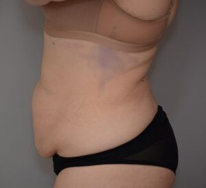 Abdominoplasty Before & After Patient #1494