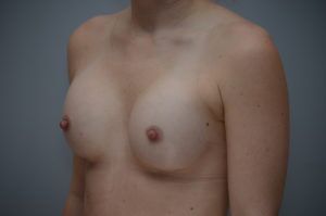 Breast Augmentation Before & After Patient #413