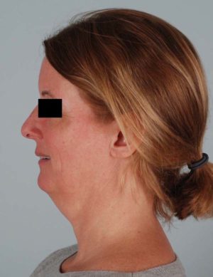 Face And Neck Lift Before & After Patient #1743