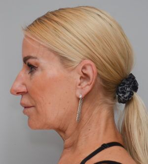 Facelift Before & After Patient #1745