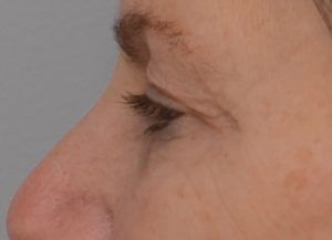 Blepharoplasty Before & After Patient #1704