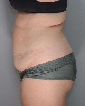 Abdominoplasty Before & After Patient #1271