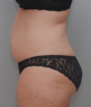 Abdominoplasty Before & After Patient #1644
