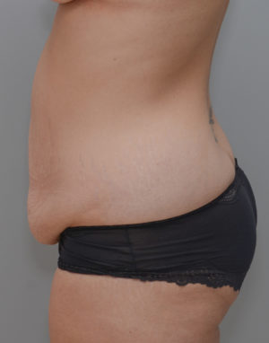 Abdominoplasty Before & After Patient #1440