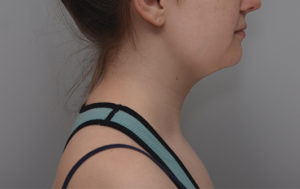 Neck Liposuction Before & After Patient #1952