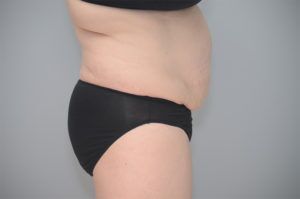 Abdominoplasty Before & After Patient #1210