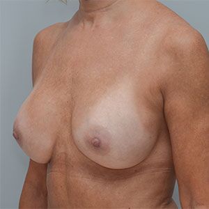 Breast Implant Exchange Before & After Patient #861