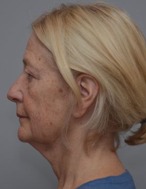 Facetite Before & After Patient #1777