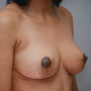 Breast Lift Before & After Patient #900
