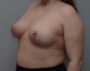 Breast Reduction Before & After Patient #1131