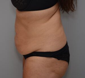 Abdominoplasty Before & After Patient #1443