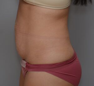 Abdominoplasty Before & After Patient #1442