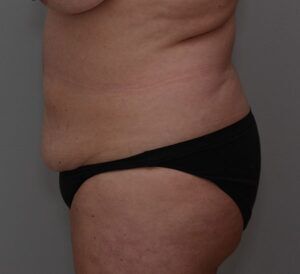 Abdominoplasty Before & After Patient #1444