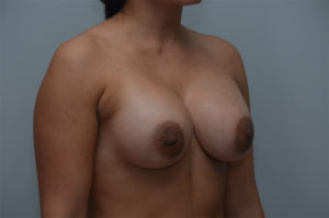 Breast Augmentation Before & After Patient #249