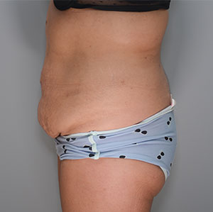 Abdominoplasty Before & After Patient #1273