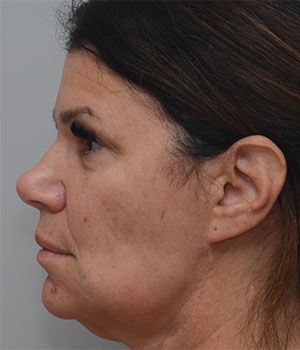 Laser Skin Resurfacing Before & After Patient #2230