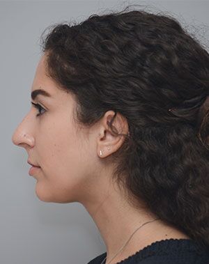 Rhinoplasty Before & After Patient #2114