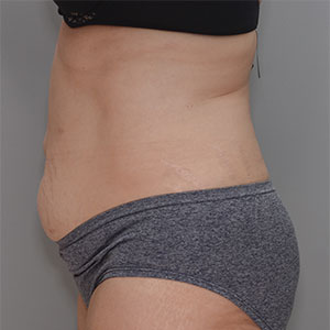 Abdominoplasty Before & After Patient #1383