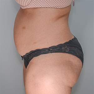 Abdominoplasty Before & After Patient #1329