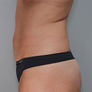 Abdominoplasty Before & After Patient #1328