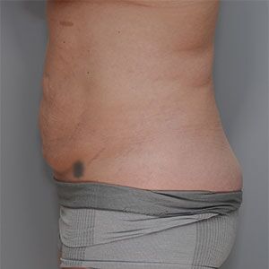 Abdominoplasty Before & After Patient #1272