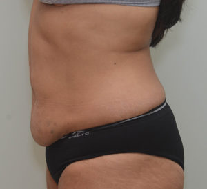 Abdominoplasty Before & After Patient #1386