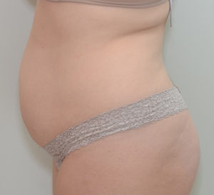 Abdominoplasty Before & After Patient #1385