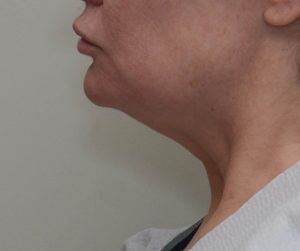 Neck Liposuction Before & After Patient #2003