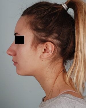 Rhinoplasty Before & After Patient #2113