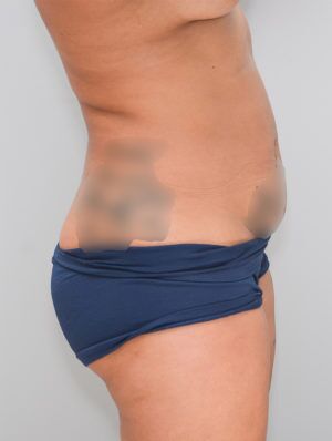 Abdominoplasty Before & After Patient #1269
