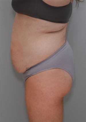Liposuction Before & After Patient #1590