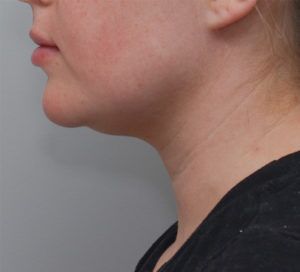 Neck Liposuction Before & After Patient #1949