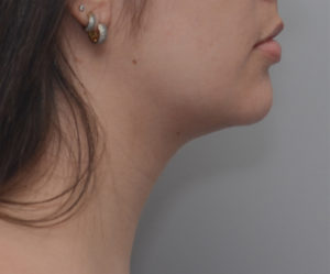 Neck Liposuction Before & After Patient #1948