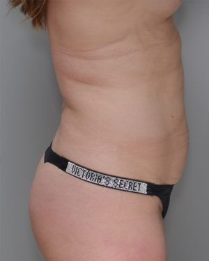 Liposuction Before & After Patient #1646