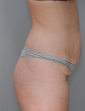 Liposuction Before & After Patient #1642