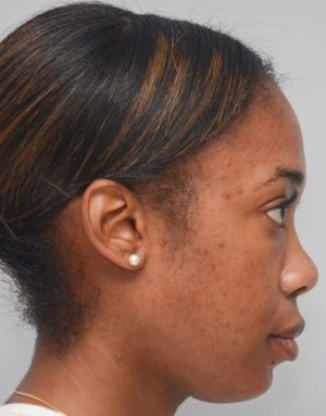 Non-Surgical Rhinoplasty Before & After Patient #2248