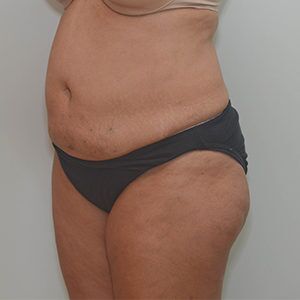 Abdominoplasty Before & After Patient #1207