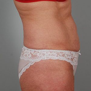 Abdominoplasty Before & After Patient #1209