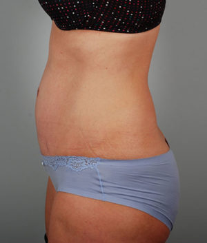 Abdominoplasty Before & After Patient #1330