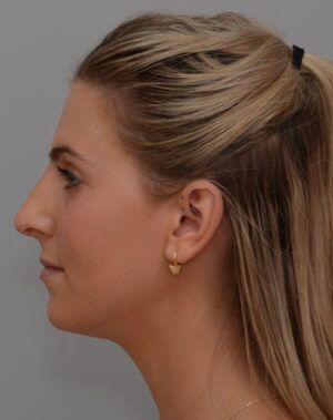 Rhinoplasty Before & After Patient #2115