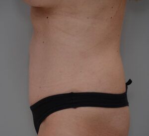 Abdominoplasty Before & After Patient #1493