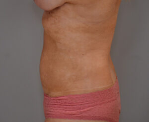 Liposuction with Bodytite Before & After Patient #1558